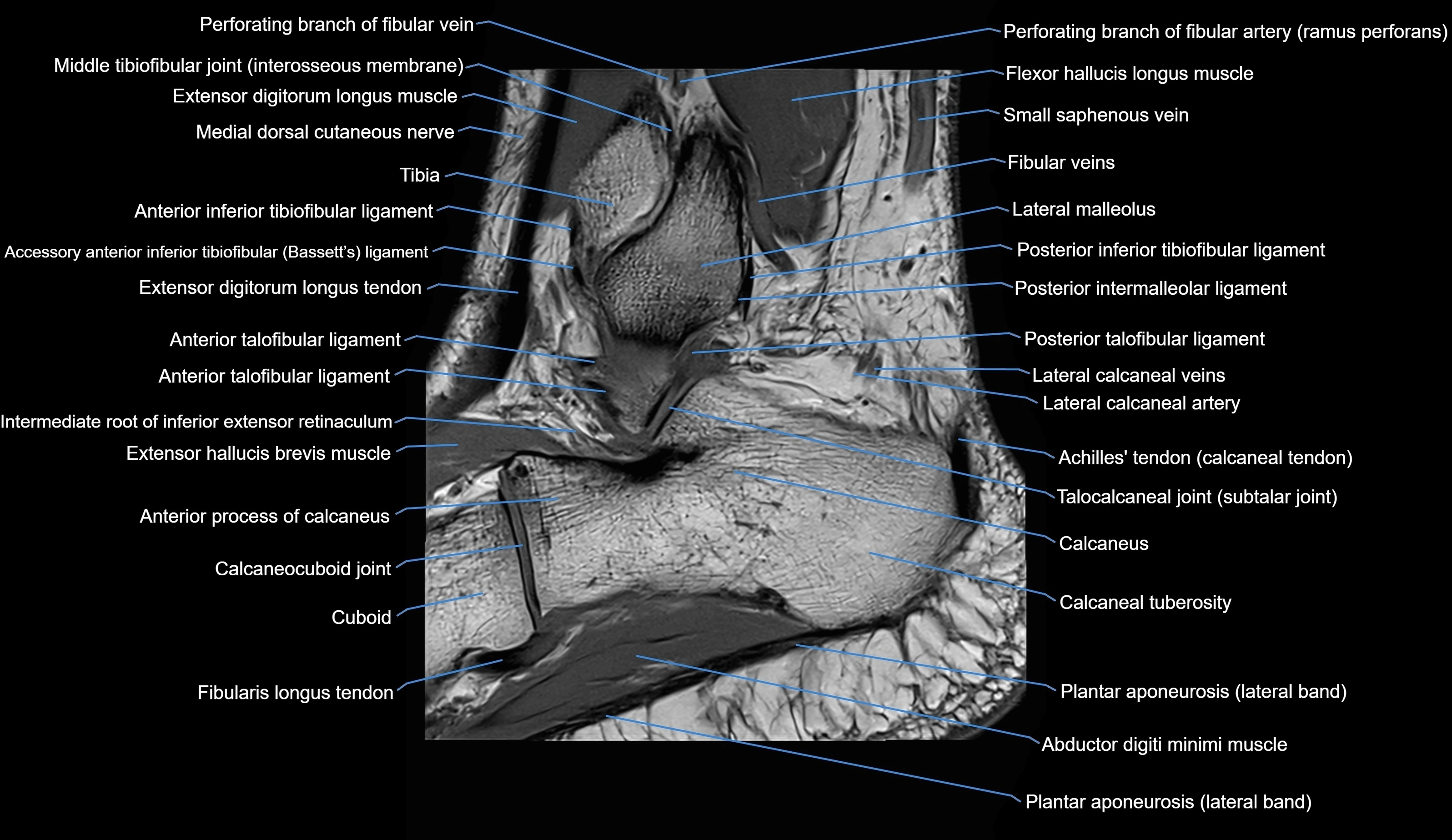 MRI Ankle sagittal cross sectional anatomy 3T  radiology  image-img-00001-00026.webp
